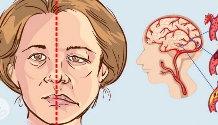 İnsultdan qorunmaq üçün nə edə bilərsən? – 7 metod