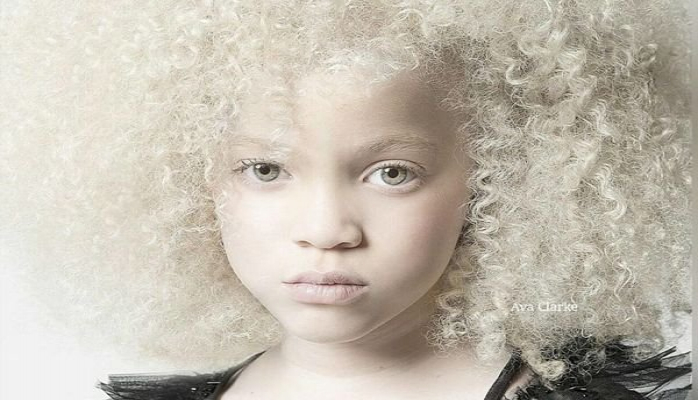 Afrikada albinos uşağın əlini kəsdilər