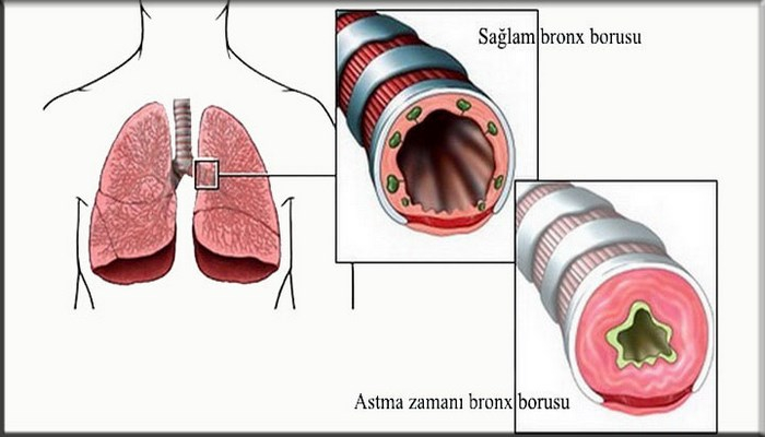 Bronxial astma