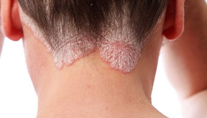 Baş dərisinin psoriazı: kəpək, ləkə, qaşınma– Səbəblər, müalicə