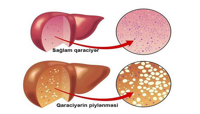 Bu 20-qəpiklik məhsul qaraciyərin yağlanmasını azaldır