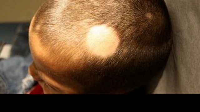 Ocaqlı keçəlləşmə (alopesiya)