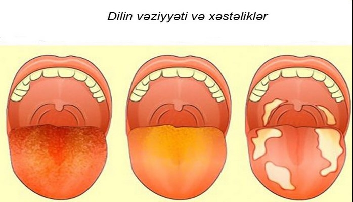 Sarı dil. Səbəblər