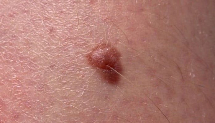 Melanomanın diaqnozu qan analizi əsasında mümkün olacaq