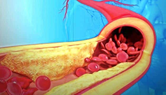 Qanı şəkər, lipid və xolesterindən təmizləyən vasitə