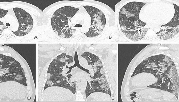 Koronavirus ağciyərləri necə dəyişir?