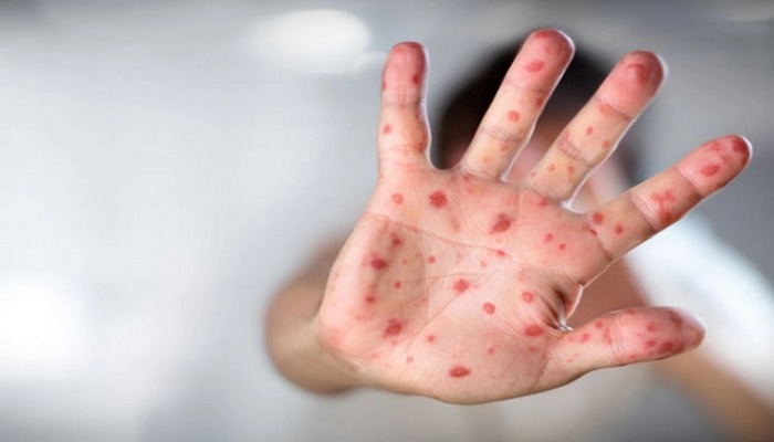 Monqolustanda qızılca epidemiyası: Minlərlə yoluxma, ilk ölüm halı