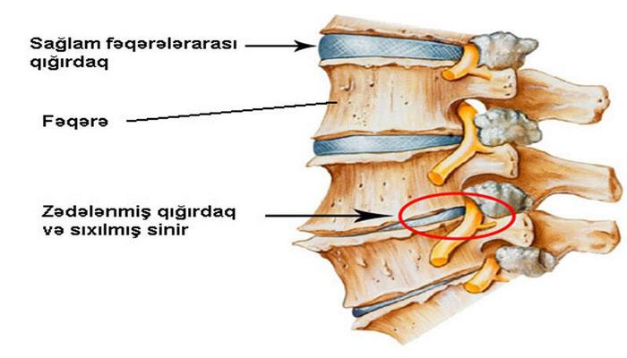 Osteoxondroz və onun müalicəsi