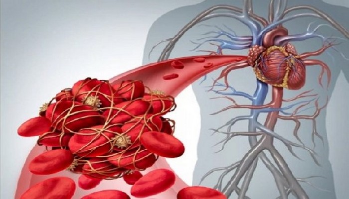 Ученые определили, что вызывает тромбоз